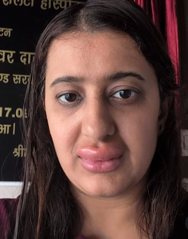 वंदे भारत में खाना खाकर महिला यात्री को हुई गंभीर एलर्जी: होंठ सूजे, बच्चे को दस्त – IRCTC का जवाब और पूरी सच्चाई